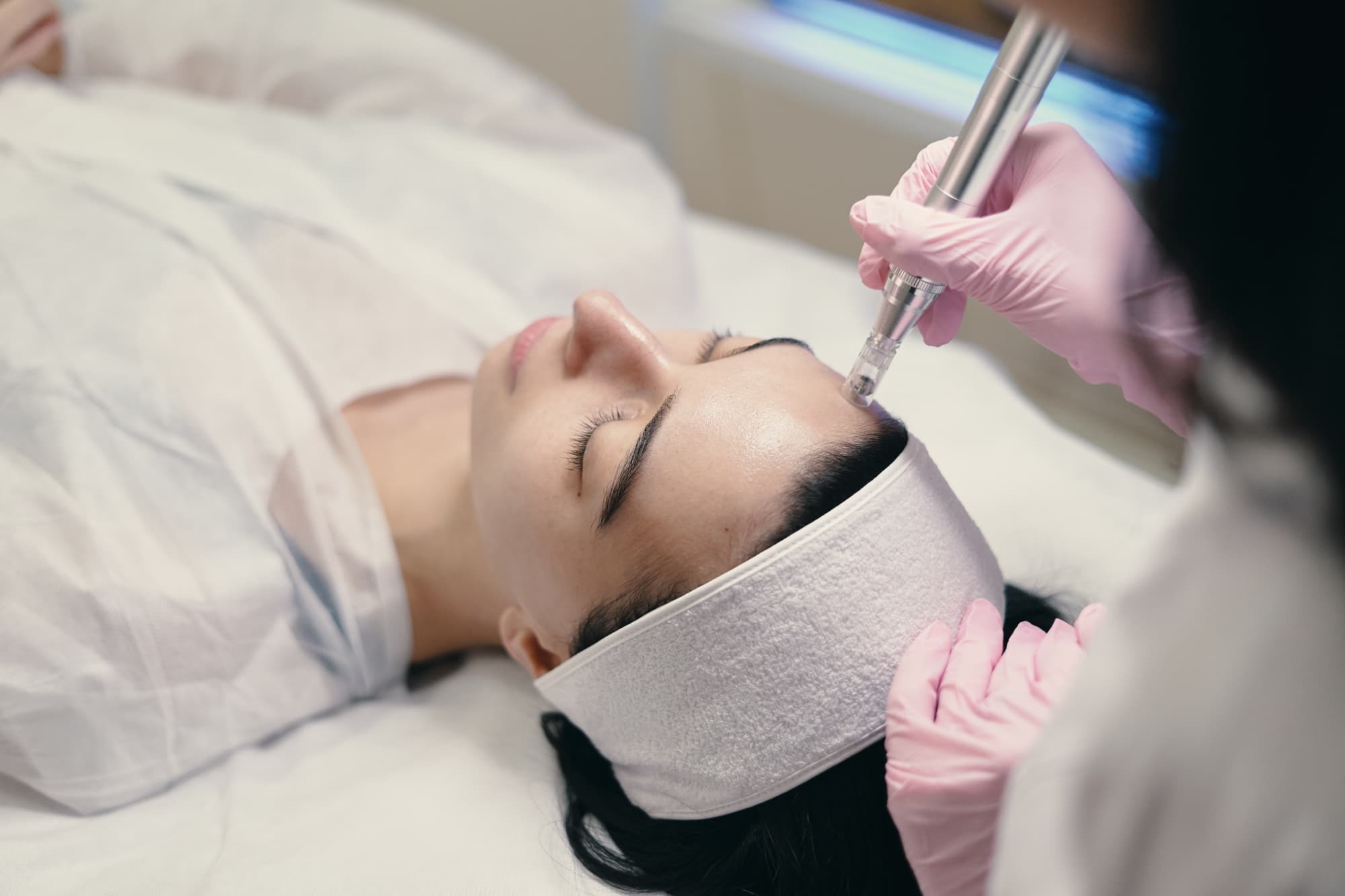 rejuran microneedling treatment on forehead