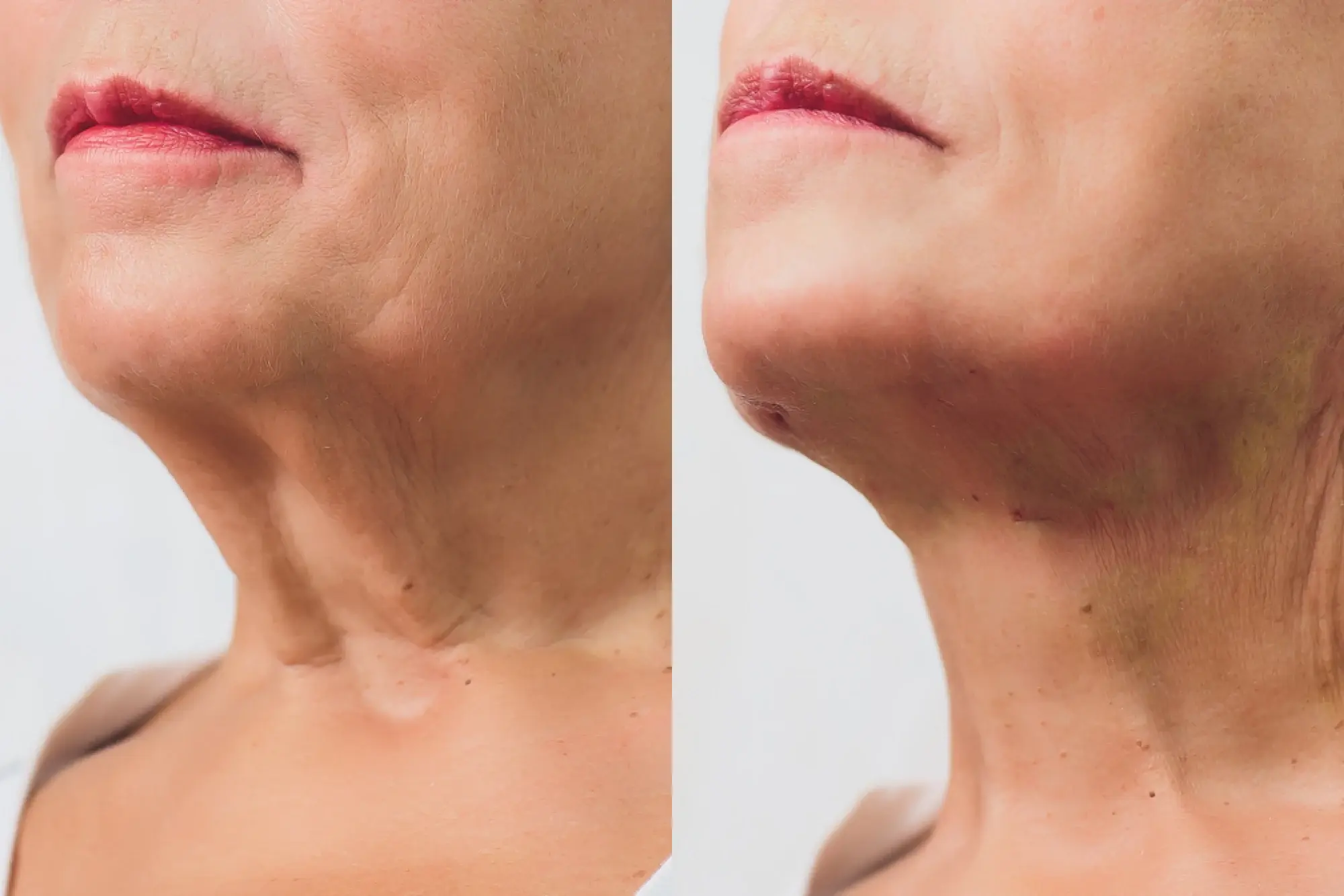 ML PDO Threads for Jowls Another Lunchtime Rejuvenation Technique