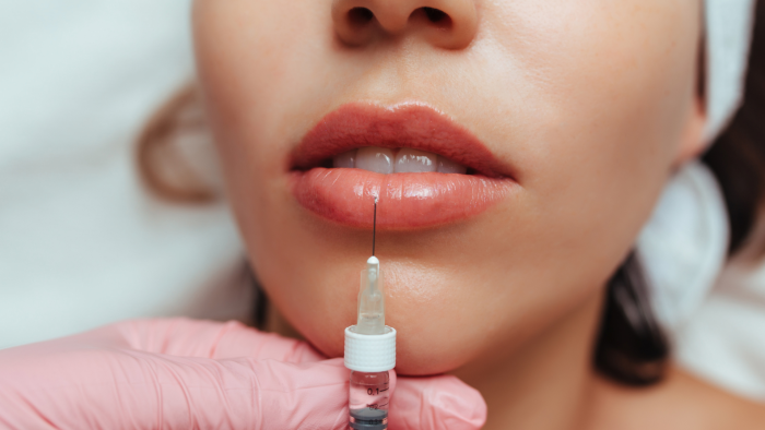 image of a woman undergoing Belotero Lip fille procedure