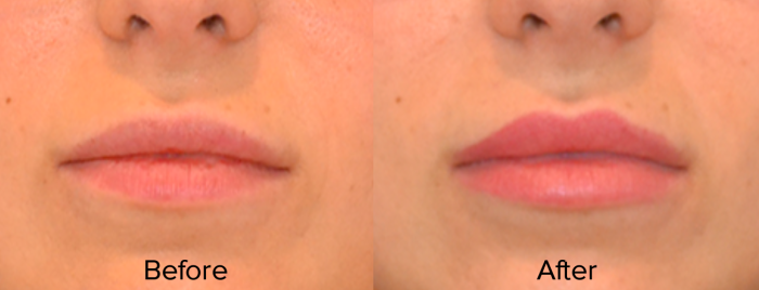 images of Belotero before and after the treatment