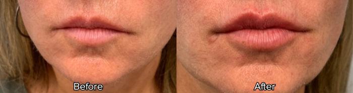 image when administered Belotero for lips to a young female patient
