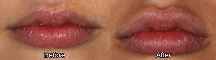 After the procedure, her lips looked plumper and better
