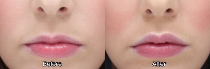 Belotero injections to outline the lips
