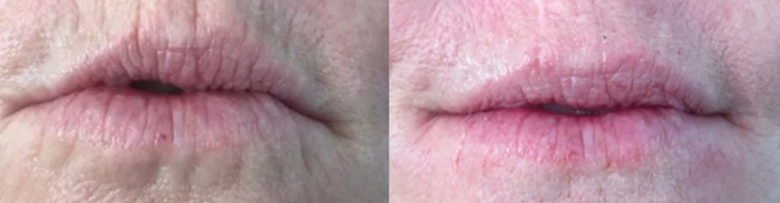 A photo showing before-and-after treatment of lips and around the mouth