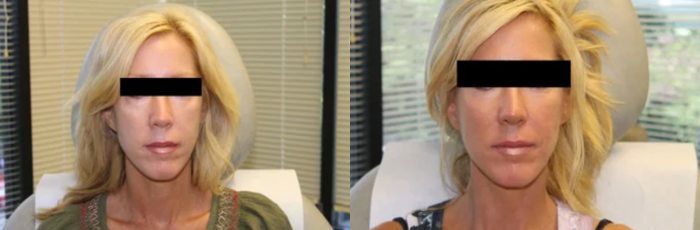 Belotero for smoothing wrinkles under the eyes