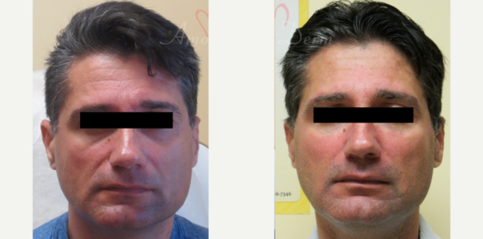 A male patient in his late 40s received under eye treatment using Belotero