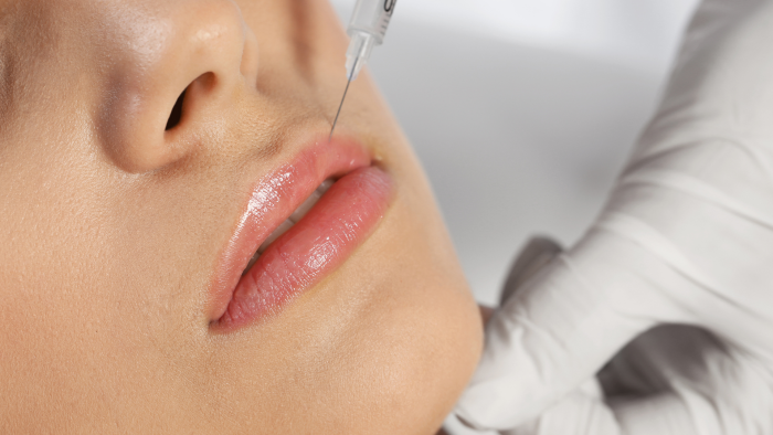 A woman getting Belotero lip injections at a luxurious med spa.