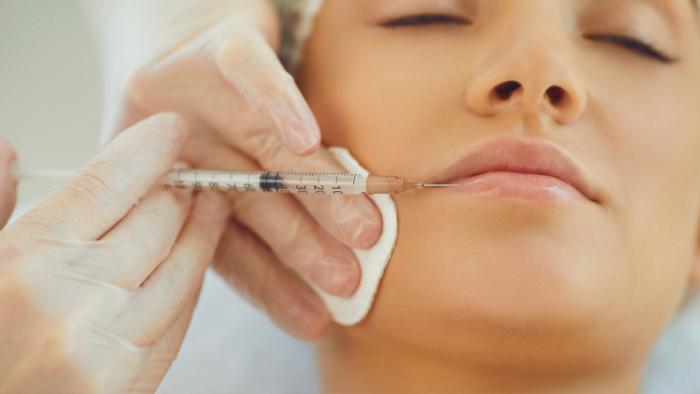 Teosyal filler being injected to enhance the lips.