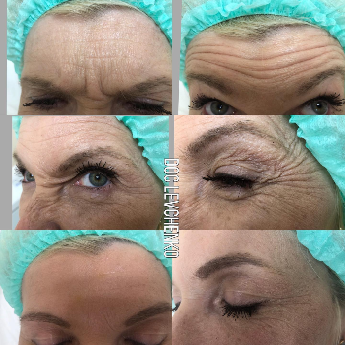 Teosyal Meso treatment for upper part of face.