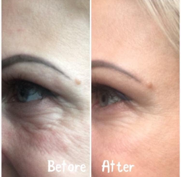 Teosyal Meso treatment for under eye rejuvenation.