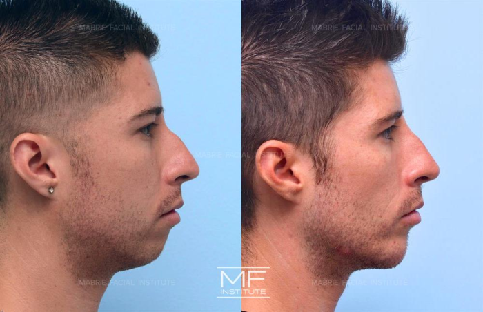 Radiesse for chin and jawline.