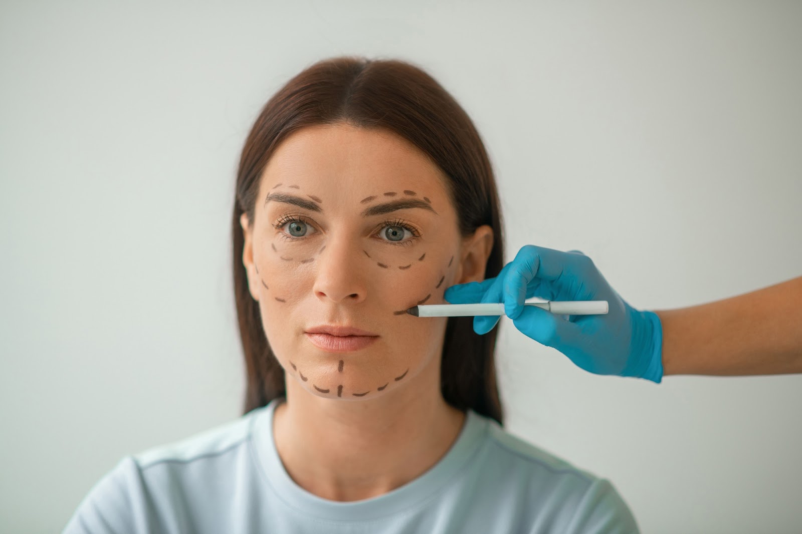 Healthcare professional adding markings to the face of a patient who will receive Radiesse for contouring.