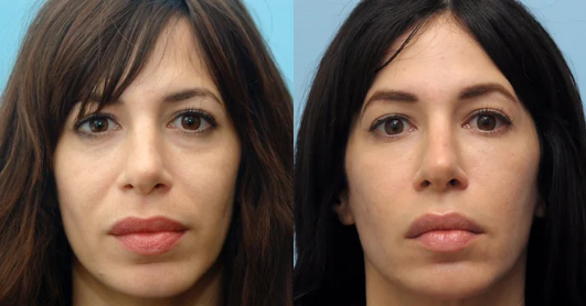 Radiesse for overall facial rejuvenation.