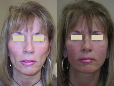 Radiesse for hollow cheeks.