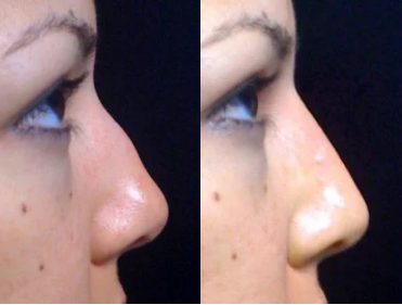 Radiesse as a lunchtime nose job.