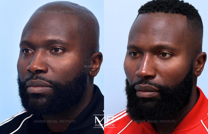 Male patient who received Radiesse treatment for facial sculpting.