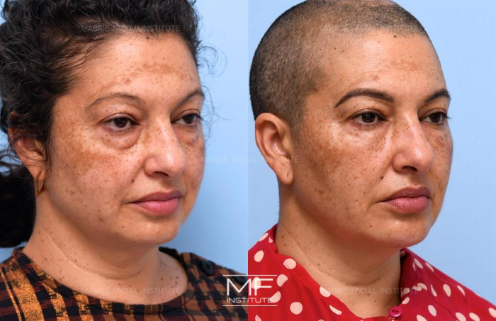 Radiesse treatments effectively delivering a bright, youthful complexion.