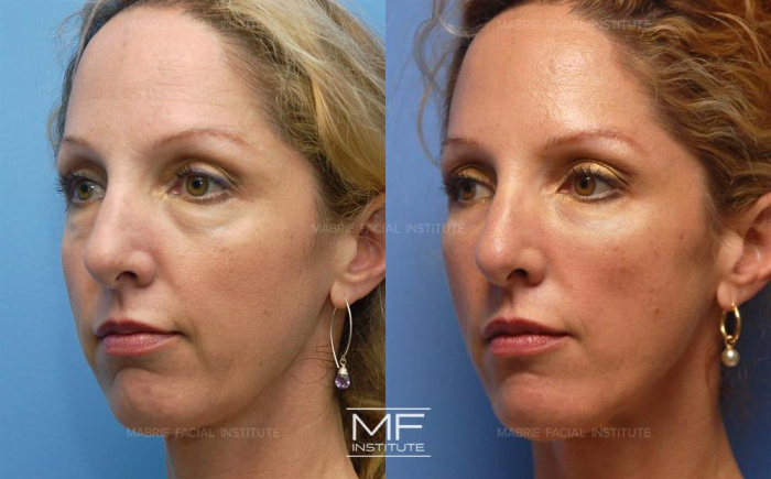 Radiesse for chin augmentation.