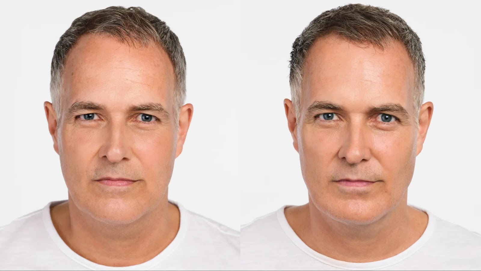 Male patient receiving Radiesse for jawline contouring.