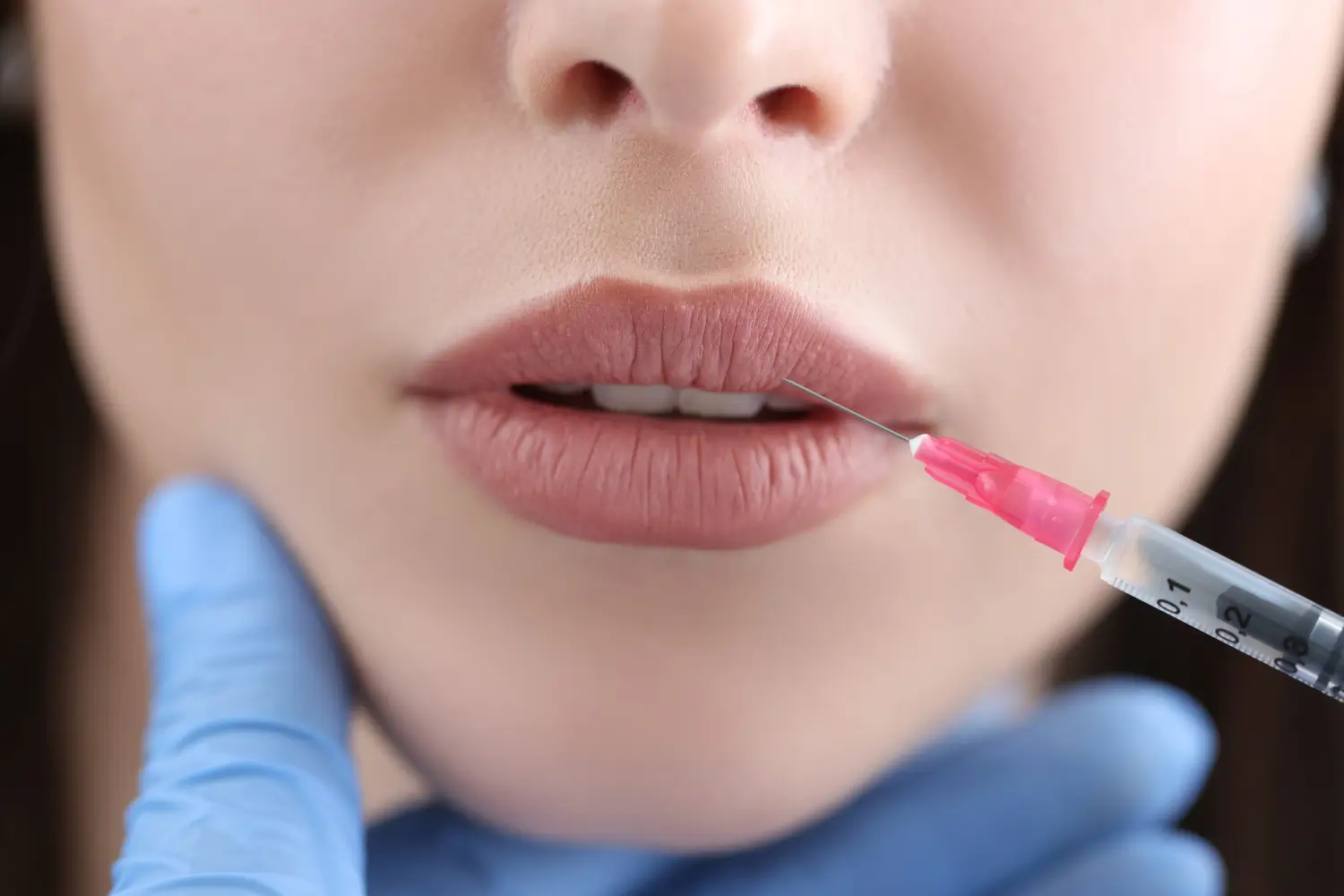 lip filler migration