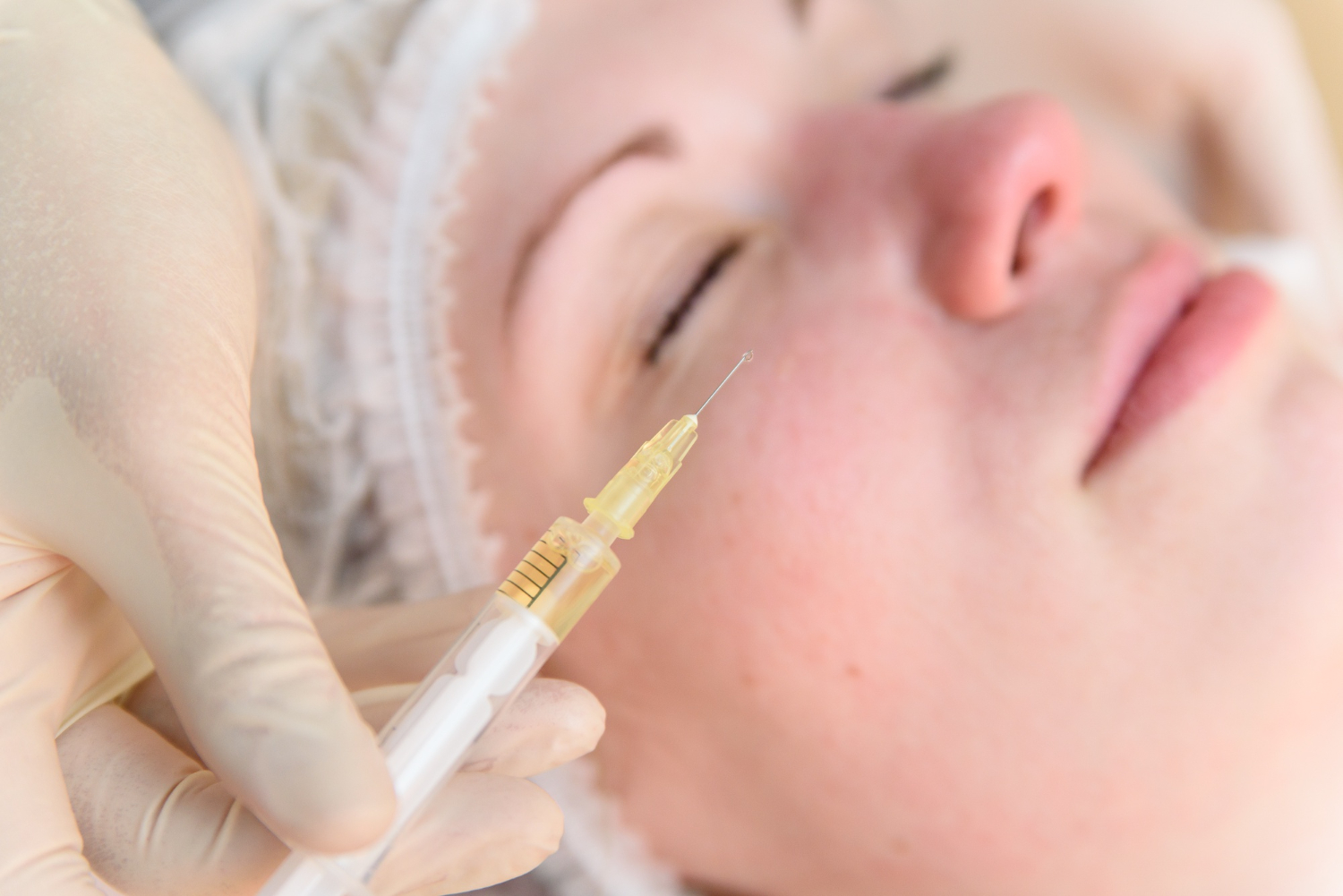 sculptra injection technique