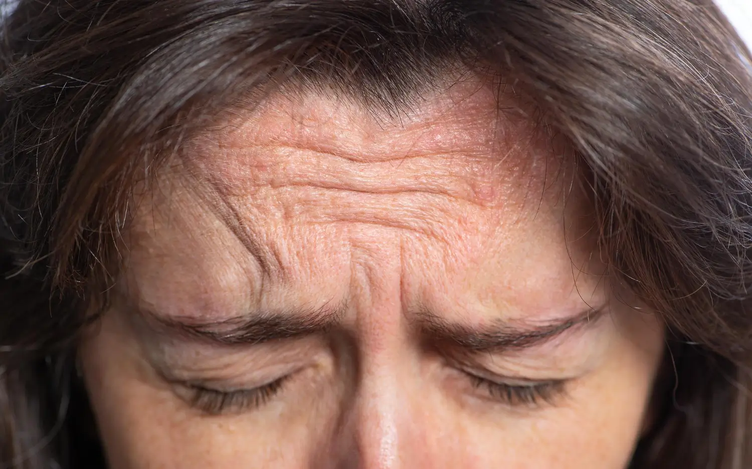 fillers in forehead