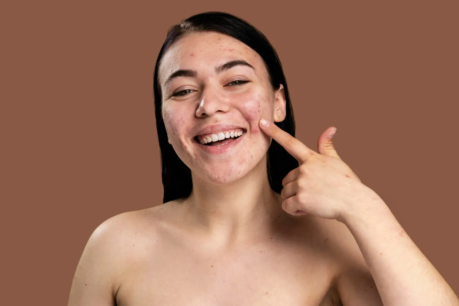 Fillers for acne scars
