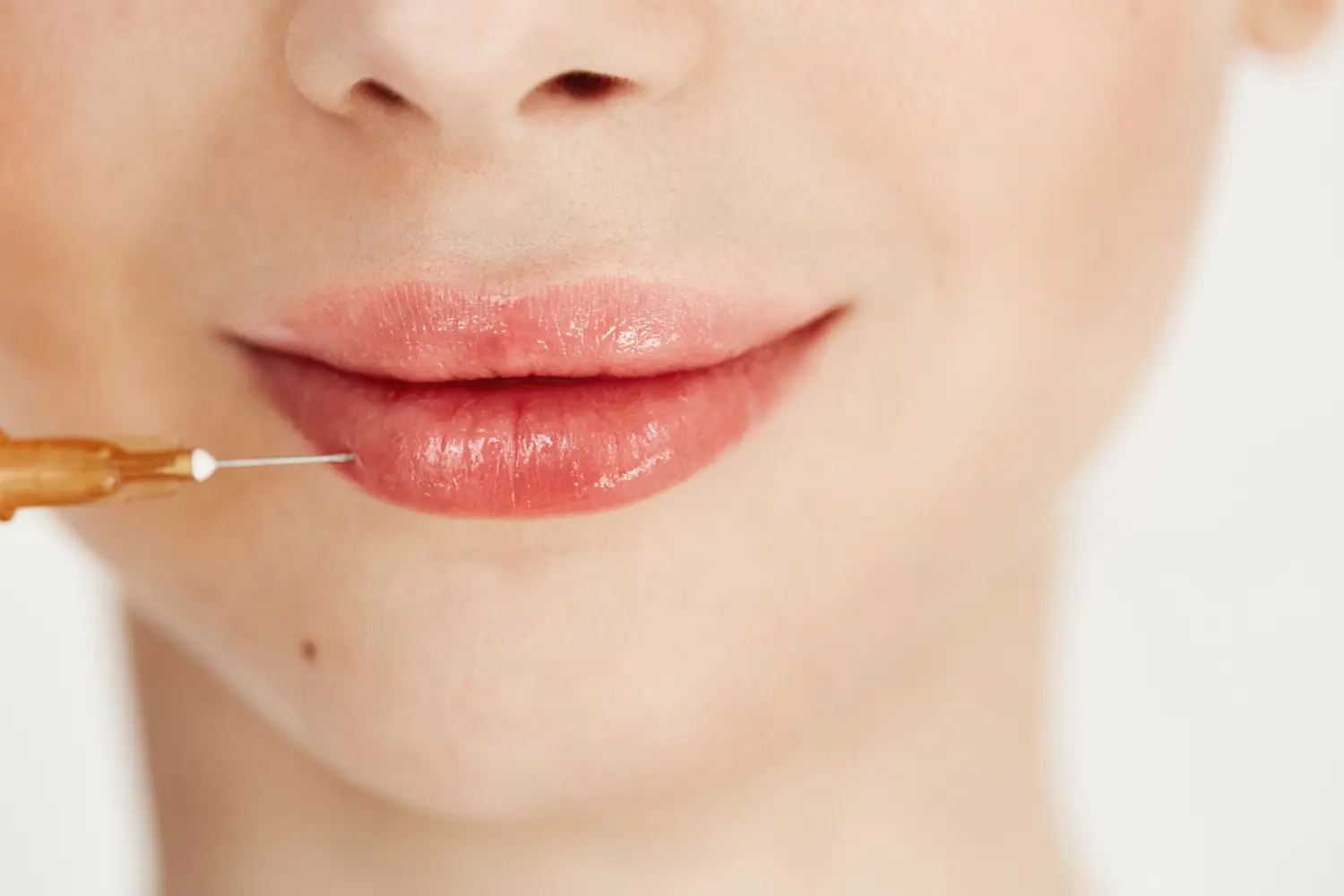 Lip filler techniques
