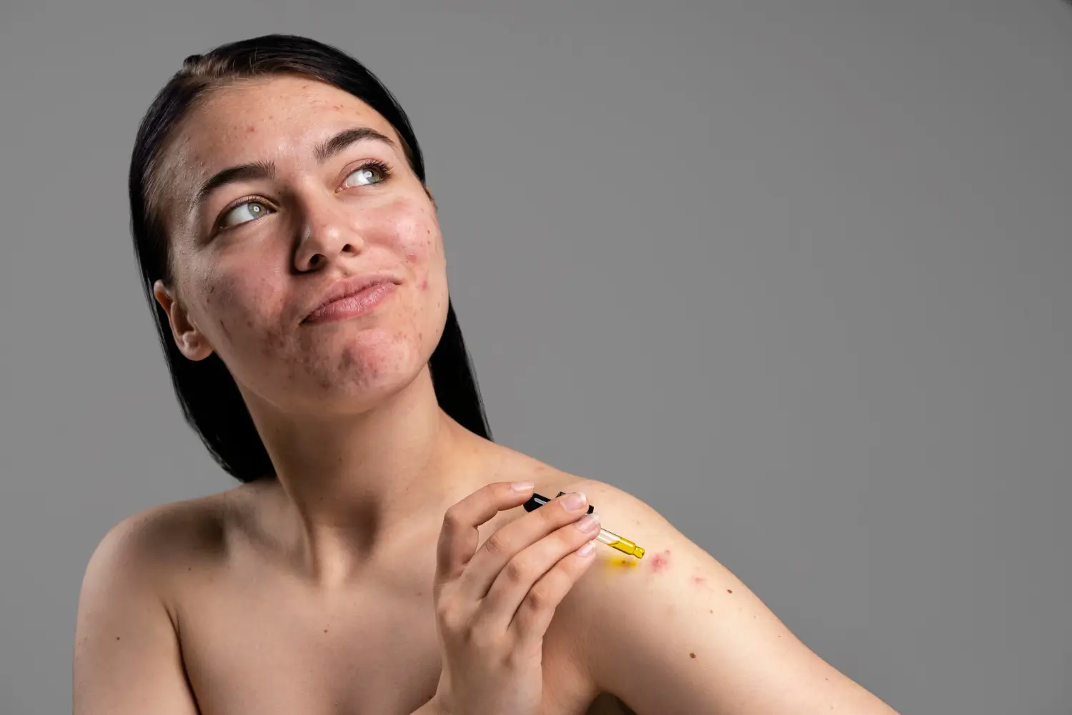 how to prevent bruising after fillers
