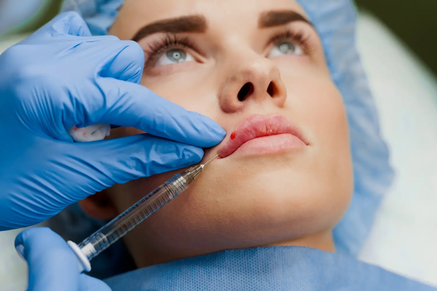 Restylane vs Juvederm