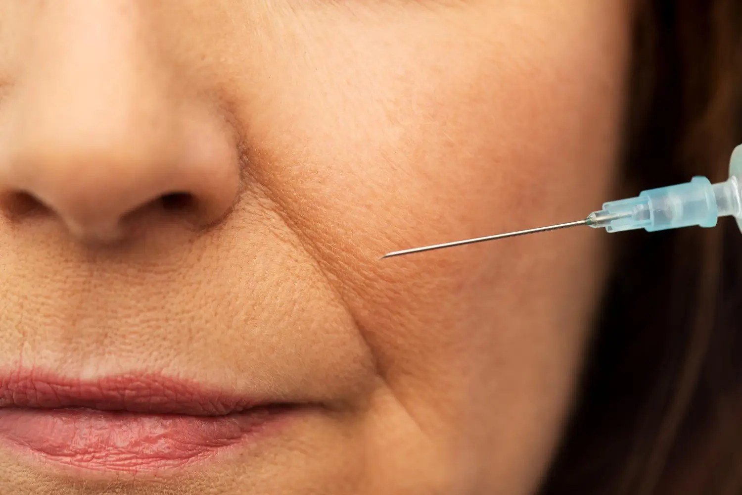 Revolax for Nasolabial folds