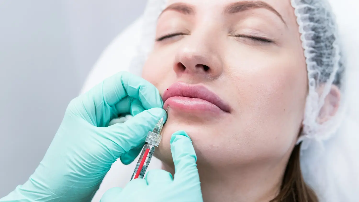 Restylane lip augmentation