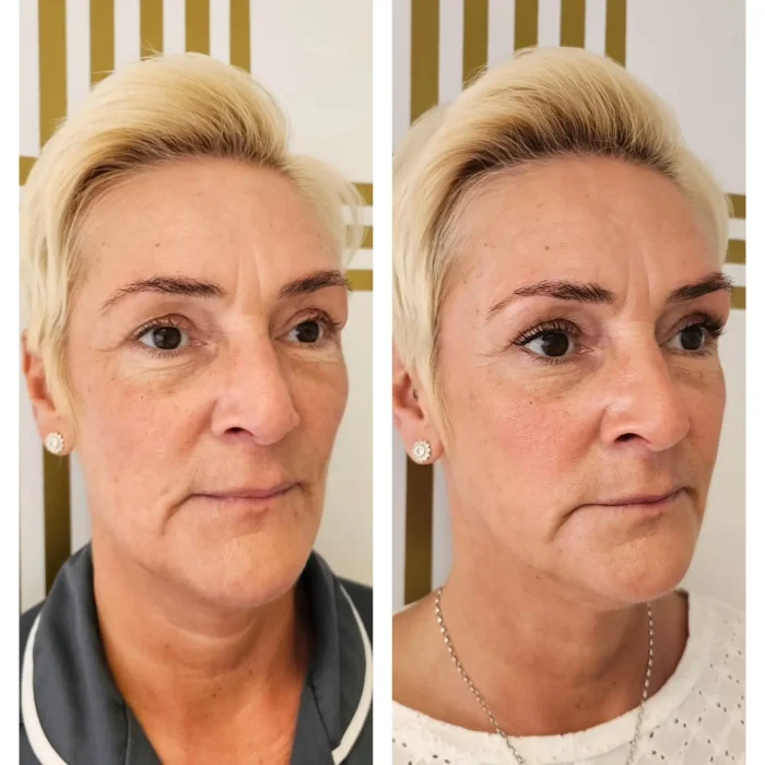 AlterEgo Aesthetics Sculptra