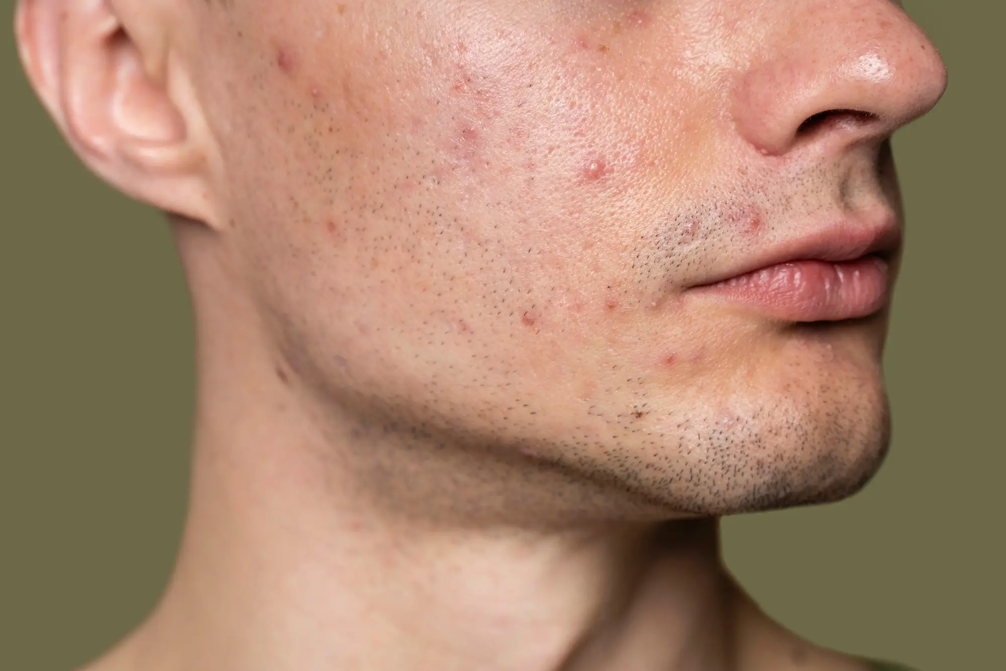 Botox For Pimples Is It a Good Treatment for Acne