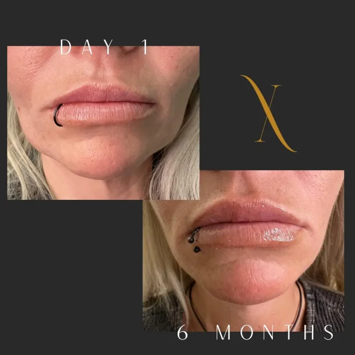 skinx sculptra (1)