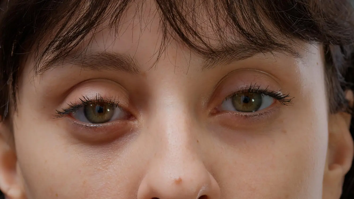 Ellanse under eye