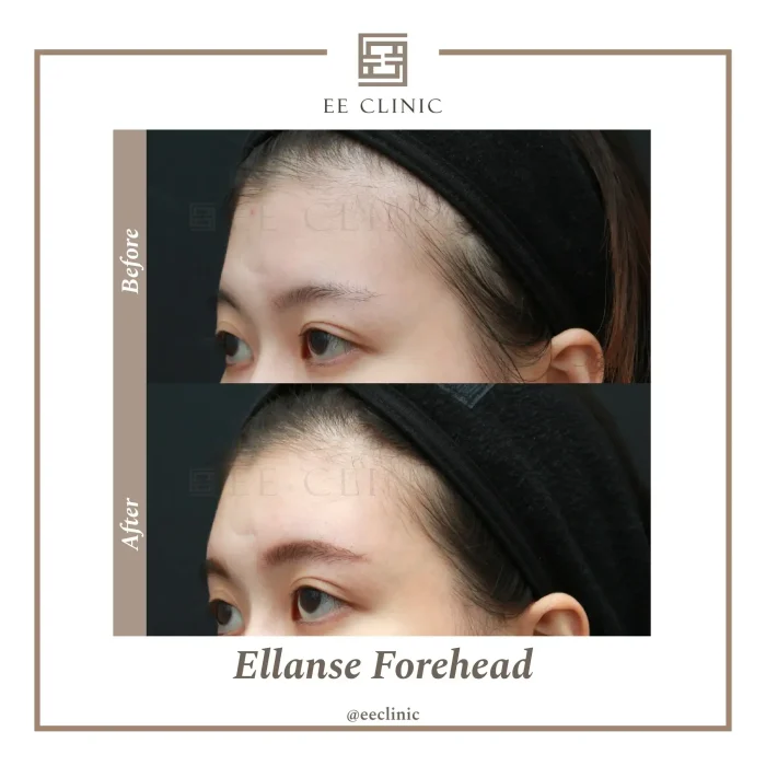 Before and after Ellanse forehead treatment