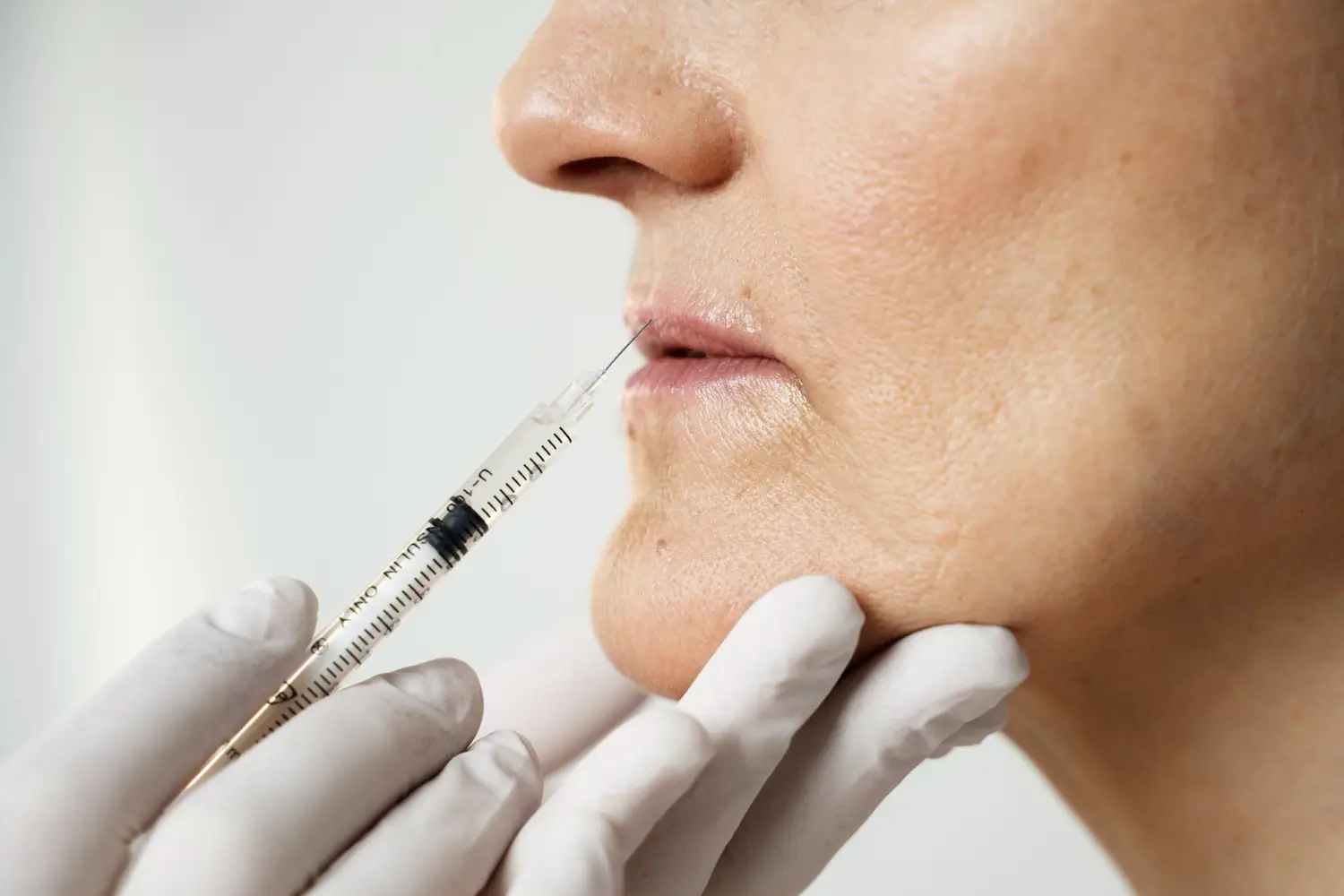 Patient receiving lip filler treatment.