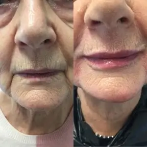 lip injection result