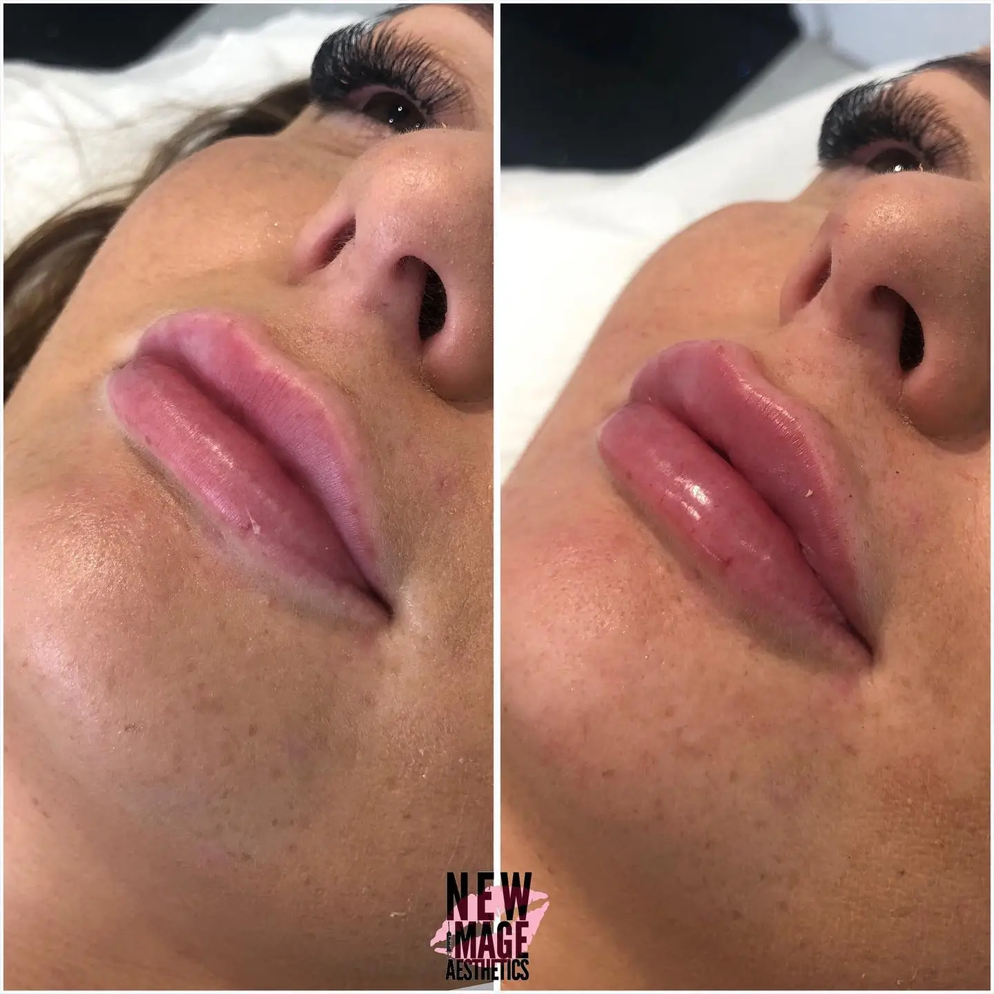 enhanced woman's lips