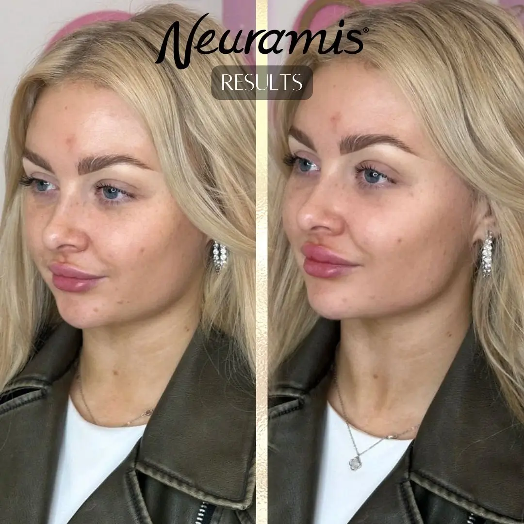 woman with enhanced lips