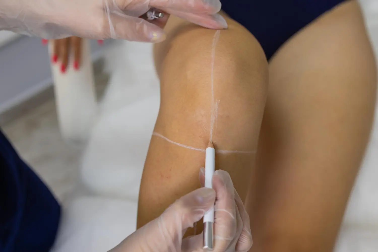 marking the injection area
