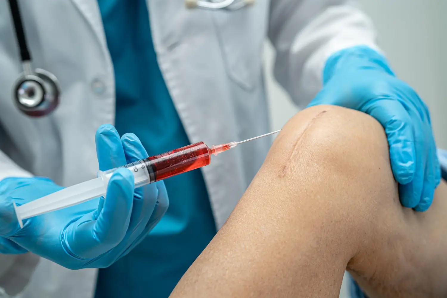 knee injection for osteoarthritis treatment