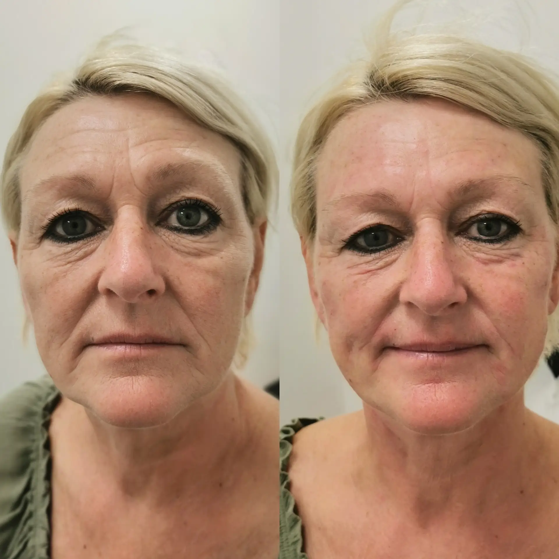 Jalupro before and after comparison