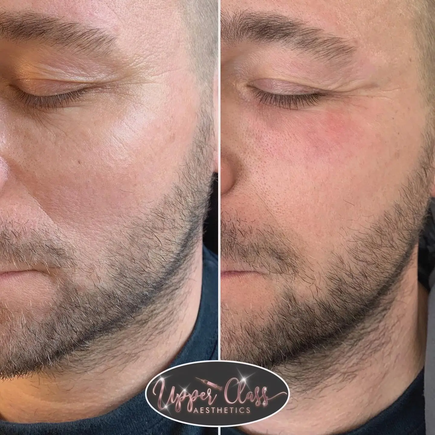 Jalupro before and after for tear troughs