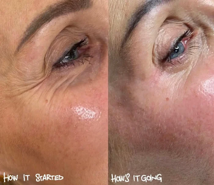 Jalupro treatment before and after 1
