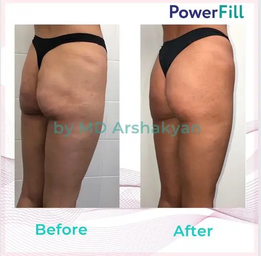 Powerfill treatment for buttocks before and after