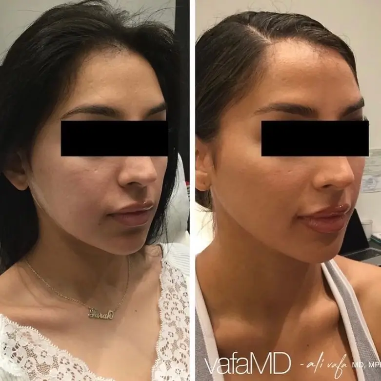 Sculptra before and after