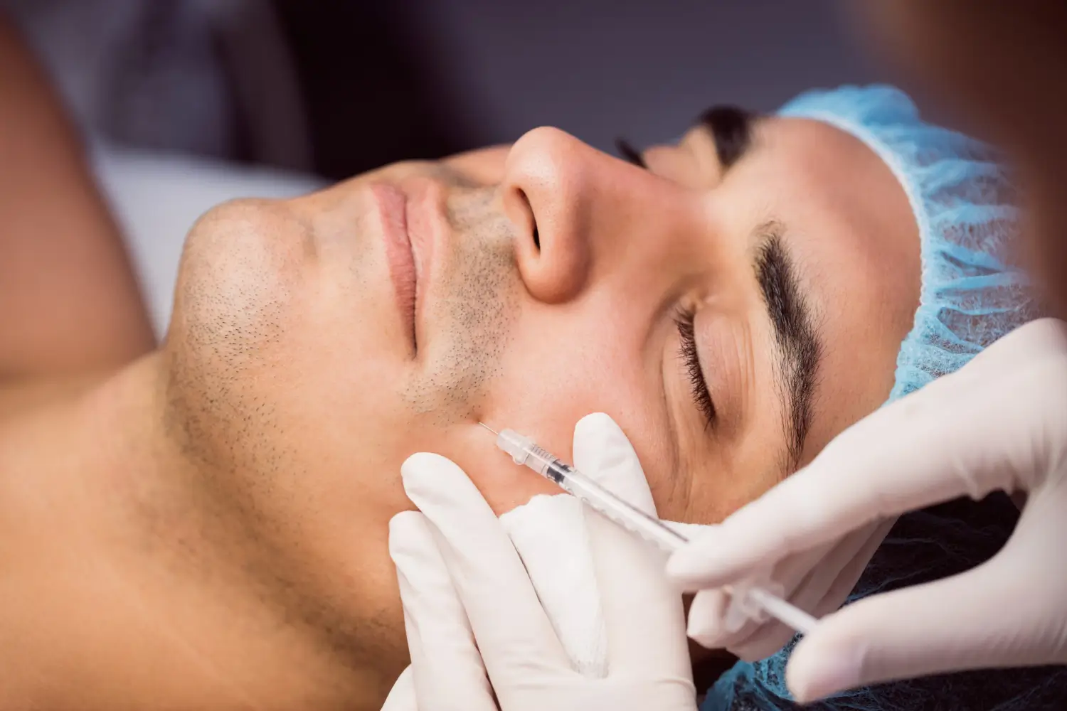 Nasolabial folds injection