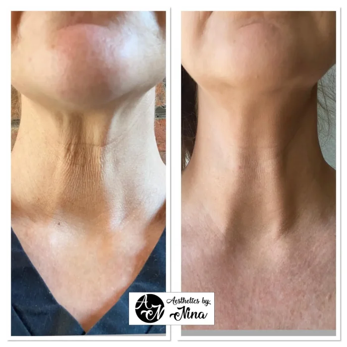 flawless neck after